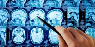 Stroke Damage Triggers Bizarre Brain Rejuvenation Hand pointing at brain scan images on screen.